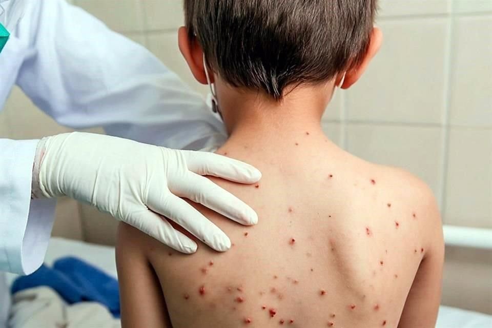 Suman 15 casos confirmados de sarampión en BC
